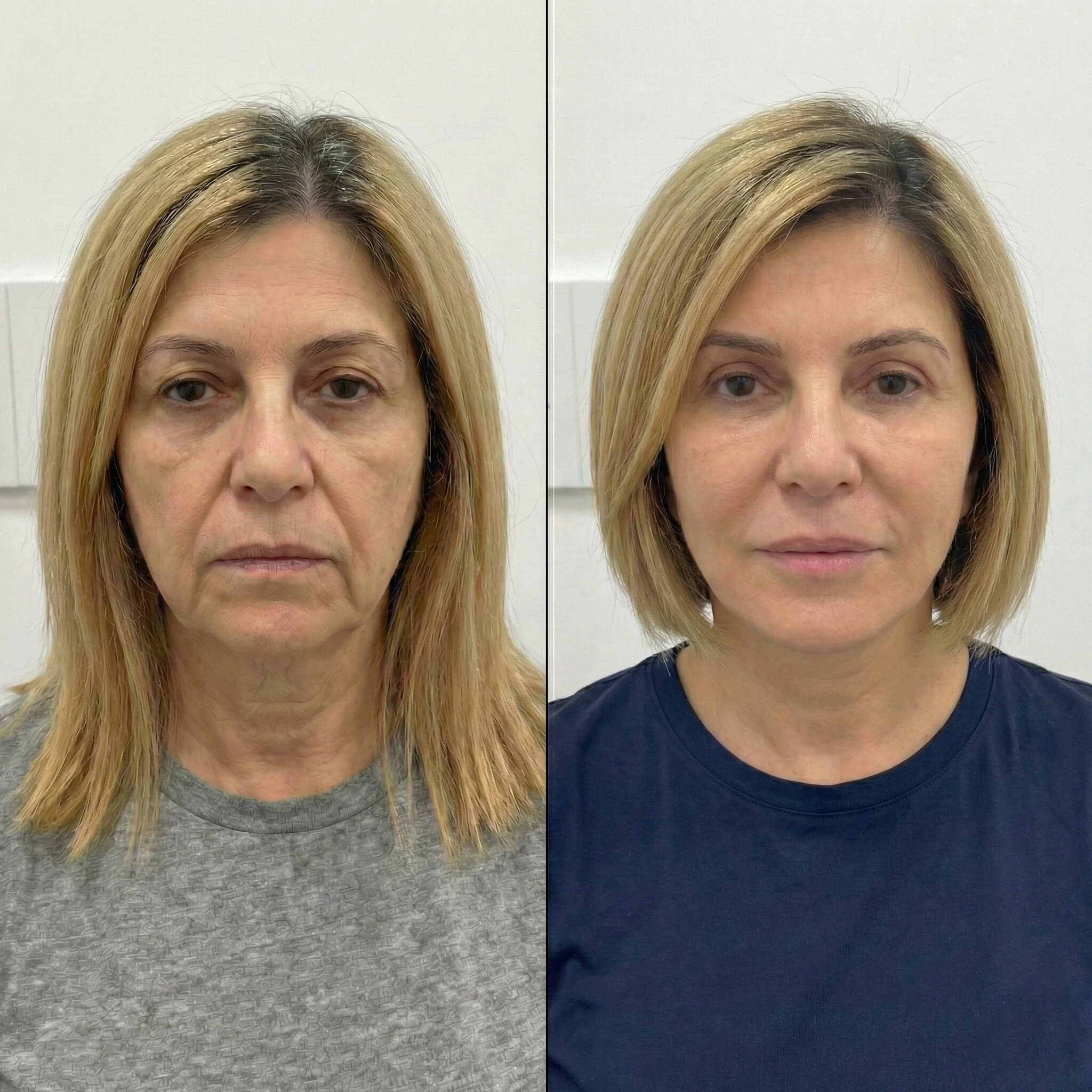 לפני ואחרי מתיחת פנים