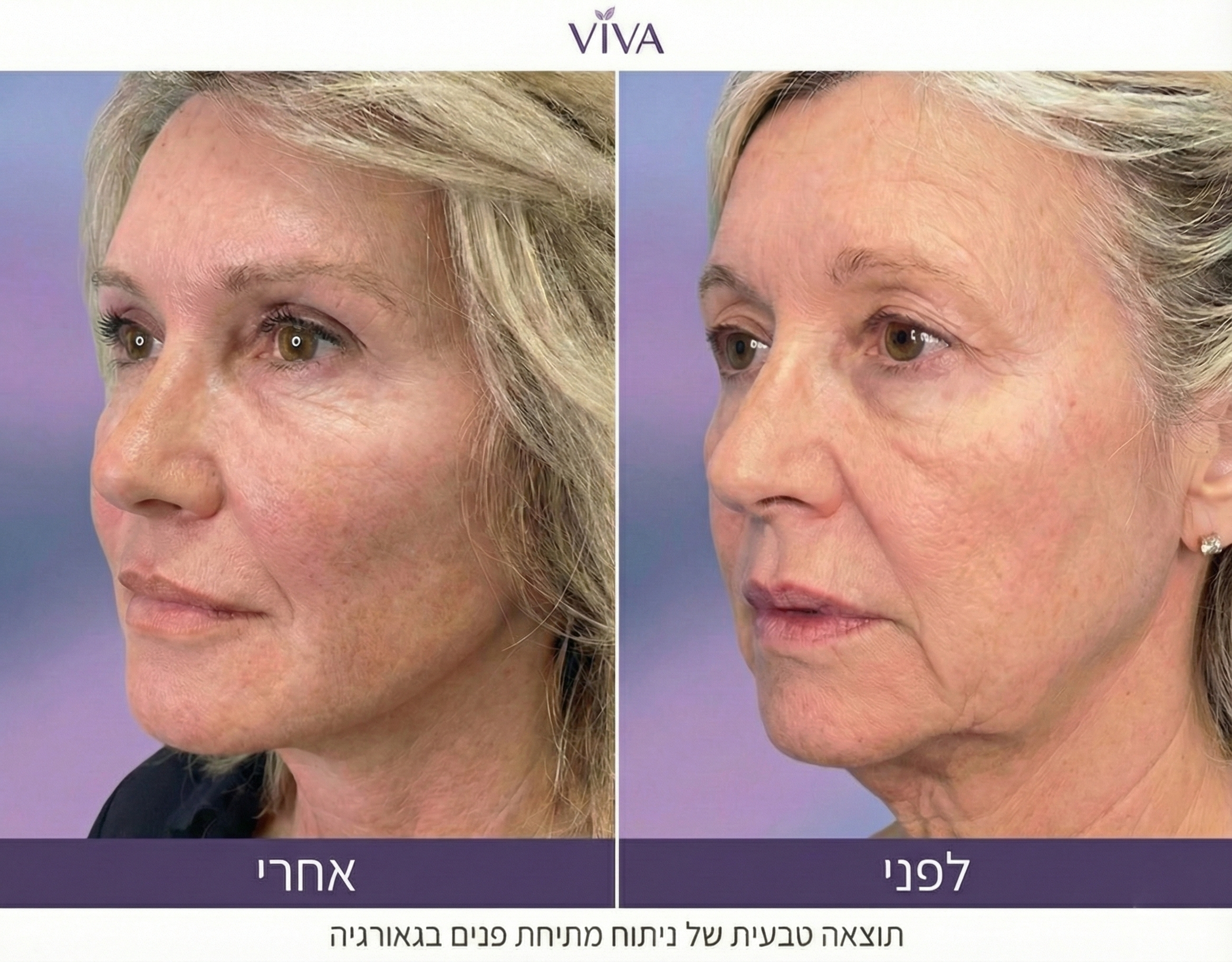 Facelift Result